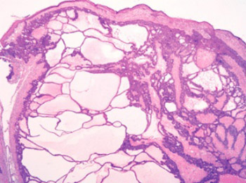 Cystic fibroepithelioma of Pinkus: two new cases and cystic changes in classical fibroepithelioma of Pinkus