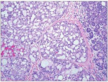Mammary Analogue Secretory Carcinoma (MASC) of the salivary gland: A  new tumor entity