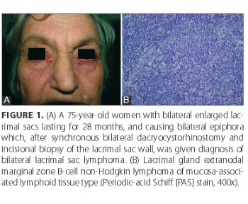 Clinical significance of routine lacrimal sac biopsy during dacryocystorhinostomy: A comprehensive review of literature