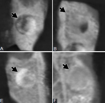 Radiopacity of alloplastic bone grafts measured with cone beam computed tomography: An analysis in rabbit calvaria