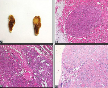 Follicular morphological characteristics may be associated with invasion in follicular thyroid neoplasms with papillary-like nuclear features