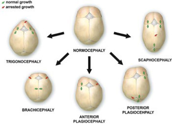 Craniosynostosis - Recognition, clinical characteristics, and treatment