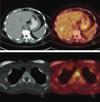 The value of 18F-FDG PET/CT imaging in breast cancer staging
