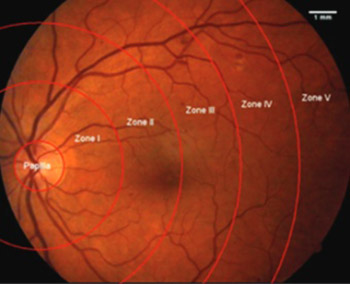 C - reactive protein and chitinase 3-like protein 1 as biomarkers of spatial redistribution of retinal blood vessels on digital retinal photography in patients with diabetic retinopathy