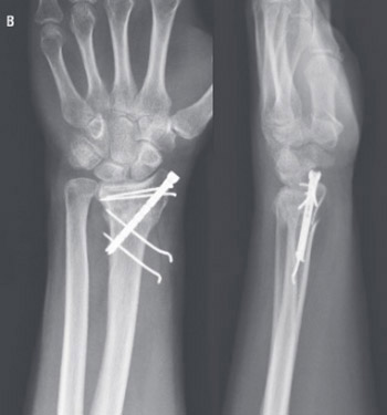 Is minimally invasive application by intramedullary osteosynthesis in comparison with volar plating real benefit in the treatment of distal radius fractures?