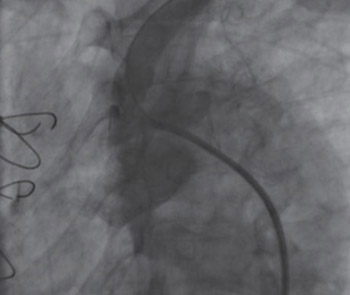 Unusual suspect-coronary subclavian steal syndrome caused severe myocardial ischemia