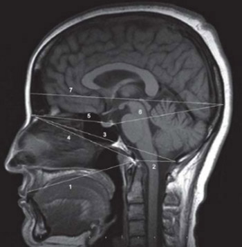 Morphometric measurements of the cranium in congenital bilateral blind males and females