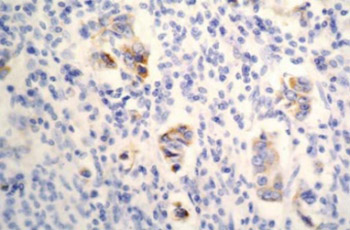 Immunohistochemical expression and significance of NM23 suppressor protein in primary gastric adenocarcinoma