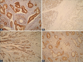 Immunohistochemical expression of NEDD9, E-cadherin and γ-catenin and their prognostic significance in pancreatic ductal adenocarcinoma (PDAC)
