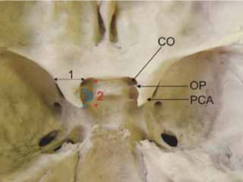 Anatomical variations and morphometric study of the optic strut and the anterior clinoid process