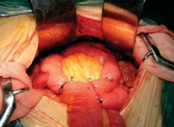 The effect of continuous jejunal interposition on gastrointestinal hormones after distal gastrectomy