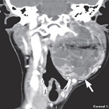 Collet Sicard syndrome as atypical presentation of neck fibrosarcoma: a case report