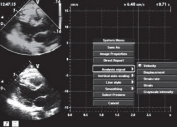 Evaluation of left ventricular hypertrophy in hypertensive patients with echocardiographic myocardial videodensitometry normalized by displacement