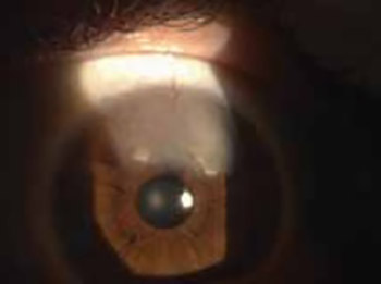 Ocular manifestation of rheumatoid arthritis-different forms and frequency