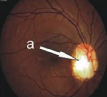 Optic Disc Abnormalities – Diagnosis, Evolution and Influence on Visual Acuity
