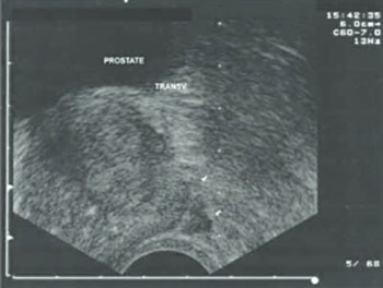 Transrectal Ultrasound-Guided Prostate Biopsy, Periprostatic Local Anesthesia and Pain Tolerance