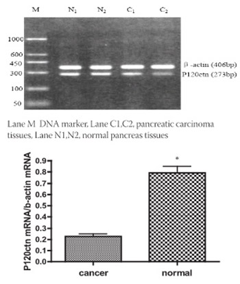 Expression and Clinical Significance of P120 Catenin mRNA and Protein in Pancreatic Carcinoma