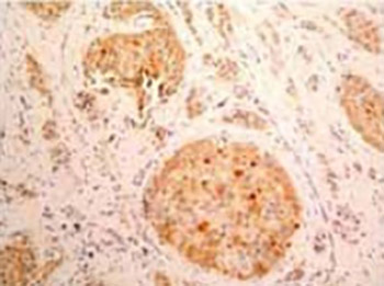 Immunohistochemical Expression of Tissue Inhibitor of Metalloproteinase-1 (Timp-1) in Invasive Breast Carcinoma