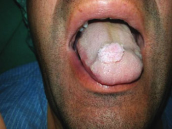 Verruca vulgaris of the tongue: a case report with a literature review