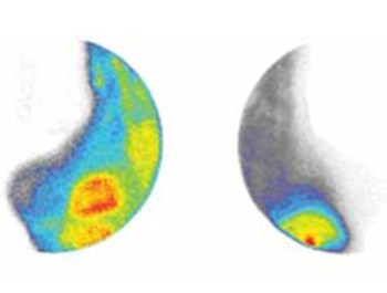 99mtc-Sestamibi Scintimammography in Detection of Recurrent Breast Cancer
