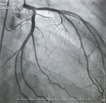 Transit Time Flowmetry in Coronary Surgery-An Important Tool in Graft Verification