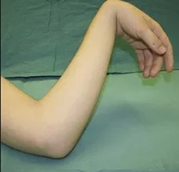 Effects of Physical Therapy in the Treatment of the Posttraumatic Elbow Contractures in the Children