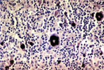 Association of Hodgkin's lymphoma with Epstein Barr virus infection