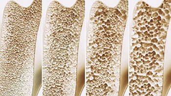 Osteoporosis - Current Trends in Diagnosis and Management