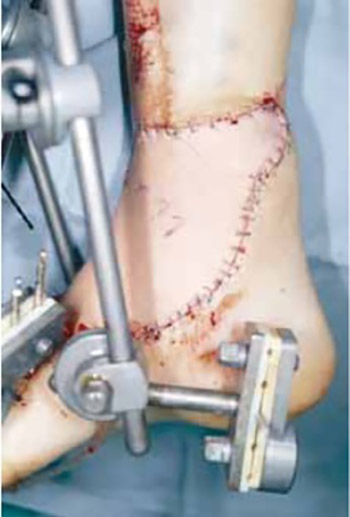 Timing of management of severe injuries of the lower extremity by free flap transfer