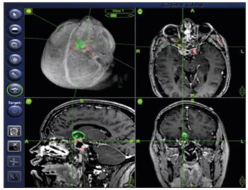 Feasibility and accuracy of a voxel-based neuronavigation system with 3D image rendering in preoperative planning and as a learning tool for young neurosurgeons, exemplified by the anatomical localization of the superior sagittal sinus