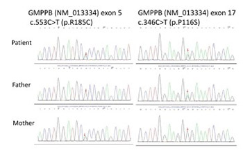 Limb-girdle muscular dystrophy due to GMPPB mutations: A case report and comprehensive literature review