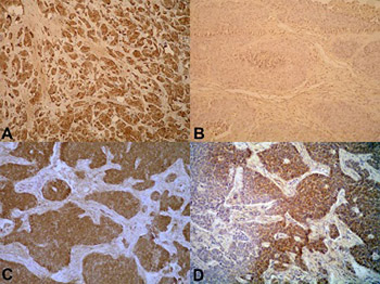 Immunohistochemistry staining images of (a) IL-6 and (c) TNF-α on