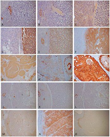 Significance of chromogranin A and synaptophysin in pancreatic neuroendocrine tumors