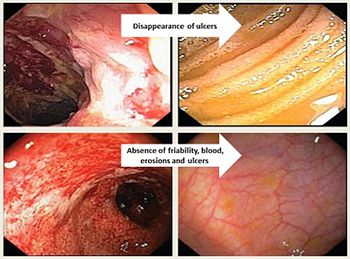 Dysbiosis of gut microbiota in inflammatory bowel disease:  Current therapies and potential for microbiota-modulating therapeutic approaches