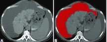 Computed tomography in the diagnosis of intraperitoneal effusions: The role of texture analysis