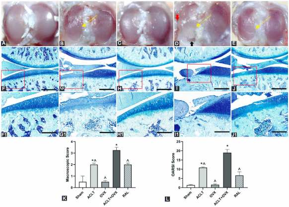 Raloxifene inhibits the overexpression of TGF-β1 in cartilage and regulates the metabolism of subchondral bone in rats with osteoporotic osteoarthritis