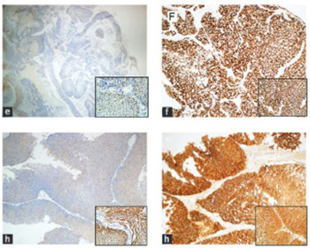Prognostic significance of survivin, β-catenin and p53 expression in urothelial carcinoma