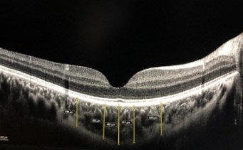 How are central foveal and choroidal thickness affected in patients with mild COVID-19 infection?