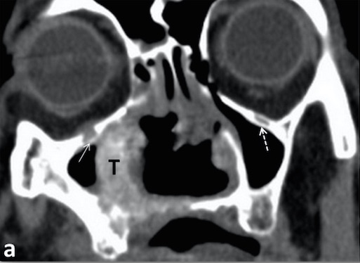 Perineural spread in head and neck malignancies: imaging findings - an updated literature review