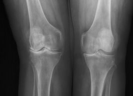 Osteoarthritis of the knee - biochemical aspect of applied therapies: a review