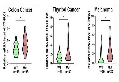 CTHRC1 is associated with BRAF(V600E) mutation and correlates with prognosis, immune cell infiltration, and drug resistance in colon cancer, thyroid cancer, and melanoma