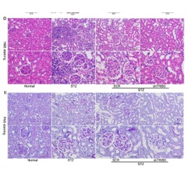Tribbles pseudokinase 3 promoted renal fibrosis by regulating the expression of DNA damage inducible transcript 3 in diabetic nephropathy