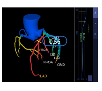AI-assisted measurements of coronary computed tomography angiography parameters such as stenosis, flow reserve and fat attenuation for predicting major adverse cardiac events in patients with coronary arterial disease