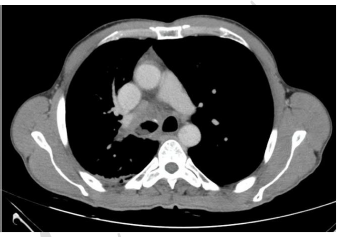 SMARCA4 deficiency in small cell lung cancer: A case report and narrative review of the literature