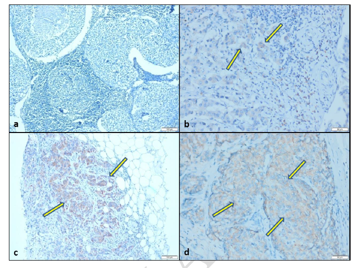 A preliminary study on the prognostic significance of cysteine-rich EGF ligand domain 2 protein (CRELD2) in patients with triple negative breast cancer