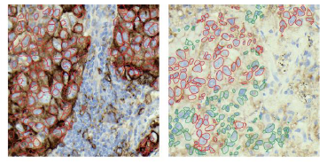 A novel deep learning framework for automatic scoring of PD-L1 expression in non-small cell lung cancer