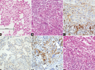 Relationship between PD-L1 expression and prognostic factors in high- risk cutaneous squamous and basal cell carcinoma