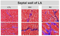 Downregulation of SIRT1 and GADD45G genes and left atrial fibrosis induced by right ventricular dependent pacing in a complete  atrioventricular block pig model