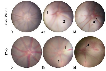 The protective effect of DNase I in retinal vein occlusion